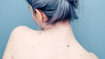 cystic-acne-on-back