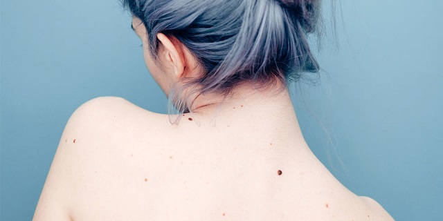 cystic-acne-on-back