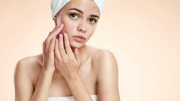 pustules-acne-causes-treatments