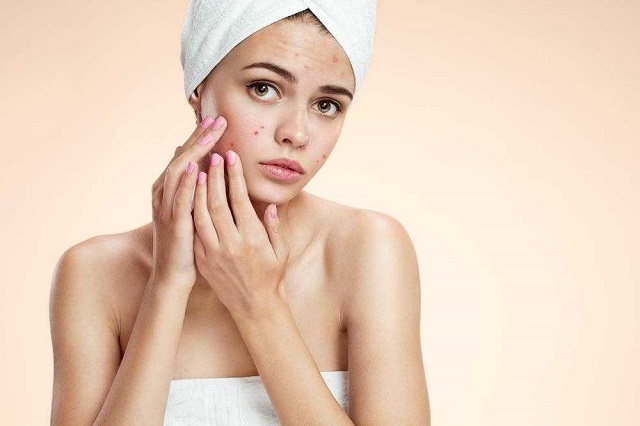 pustules-acne-causes-treatments