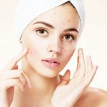Nodular-acne-causes-and-treatments