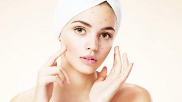 Nodular-acne-causes-and-treatments