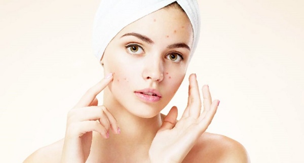 Nodular-acne-causes-and-treatments