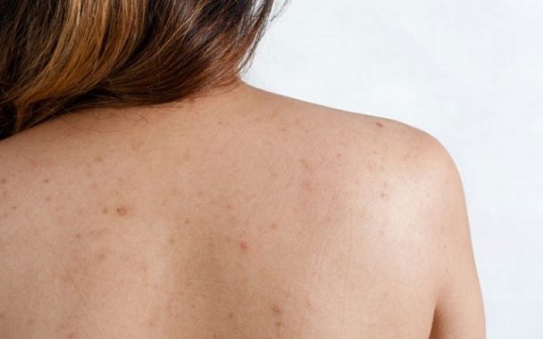 Cystic Acne On Back Causes And Treatments Benefits And Uses