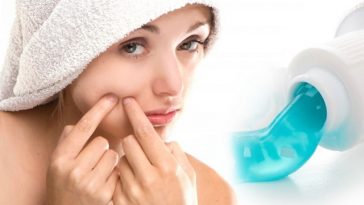 does-toothpaste-get-rid-of-pimples