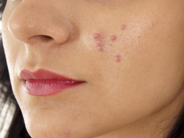 Papules Acne Causes And Treatment | Benefits And Uses