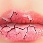home-remedies-for-chapped-lips