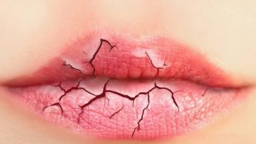 home-remedies-for-chapped-lips