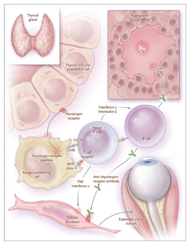 graves-can-the-graves-disease-affect-anybody-benefitsuses